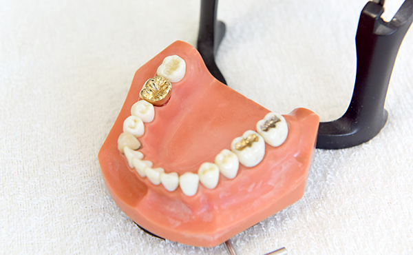 詰め物・被せ物イメージ