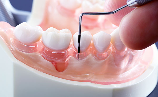 歯周病イメージ